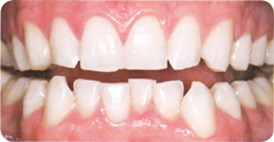 After Whitening